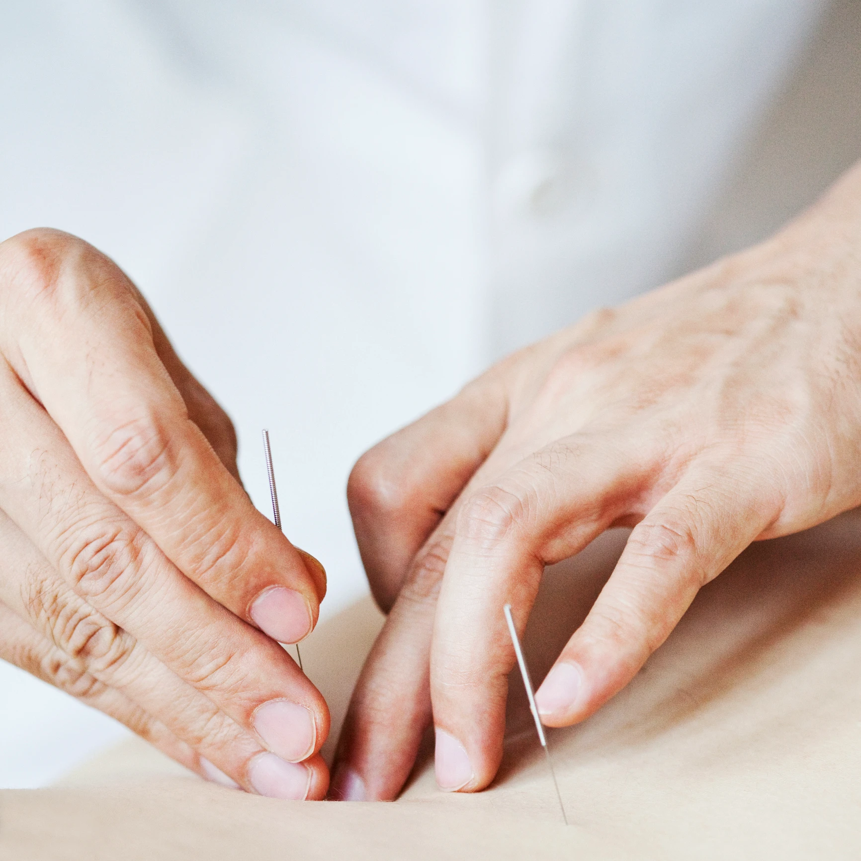 Acupuncture session with needles on skin.